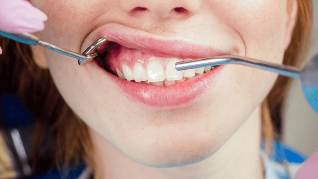Proceso de alineación dental con alineadores invisibles